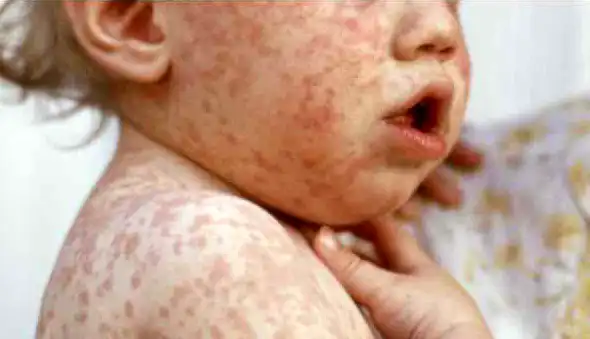 Measles Spike Is So Extreme It Threatens Elimination in the US